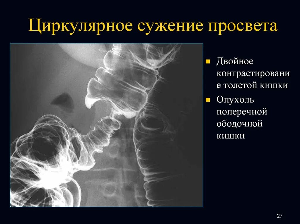 Стеноз кишечника что это. Циркулярное сужение просвета. Стриктура толстой кишки.