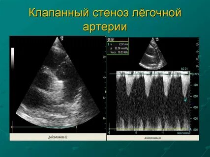 Stenosis