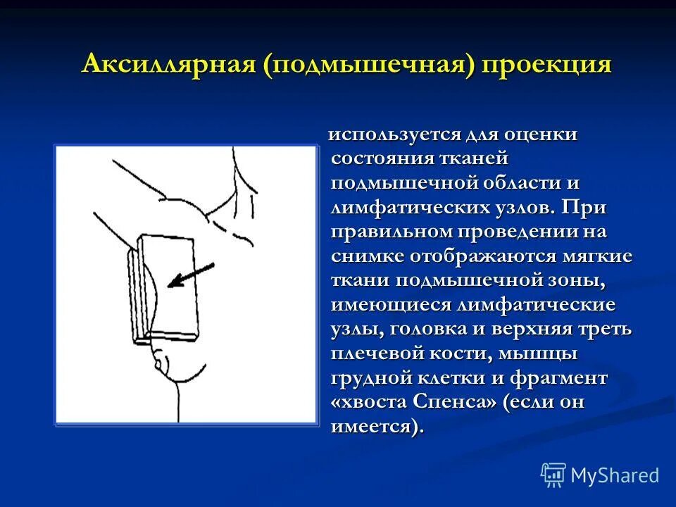 Лимфоузлы на маммограмме норма. Метастазы лимфоузлов на узи. Интрамаммарный лимфатический узел узи. Аксиллярные узлы молочной железы это что. Регионарные лимфатические узлы молочной железы.