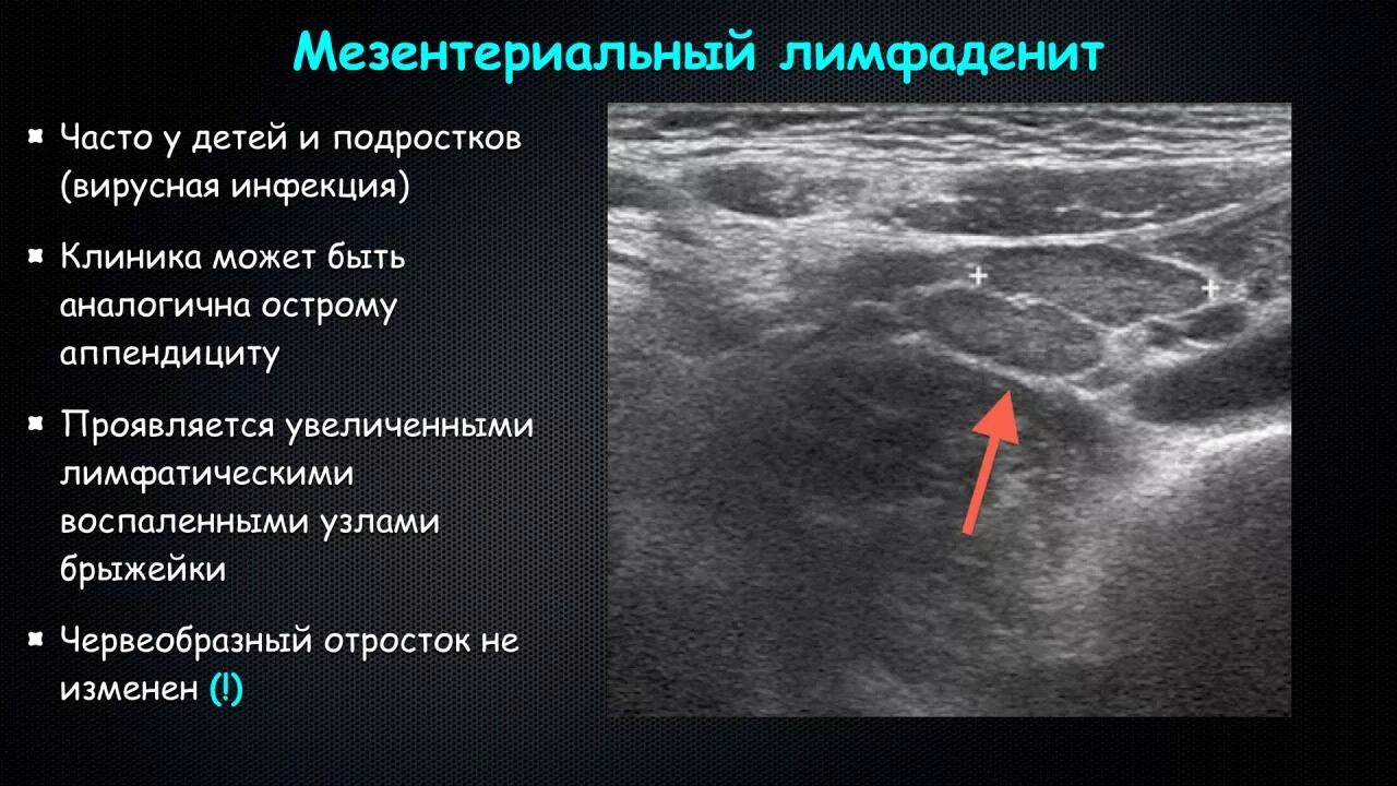 Тромбоз мезентериальных сосудов мкб. Мезентериальный тромбоз на узи. мезентериальные лимфоузлы на узи.