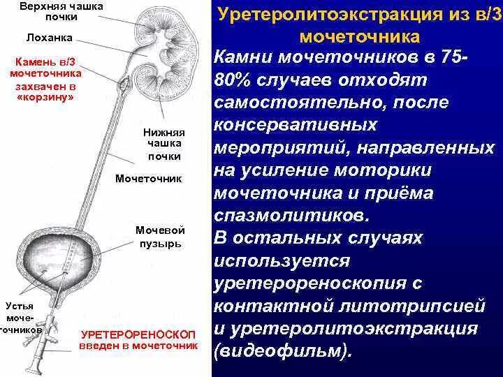 Анализ мочеточника. Камень в Устье мочеточника 3мм. Камень средней трети мочеточника. Мкб камень н/3 левого мочеточника. Нижняя треть мочеточника.