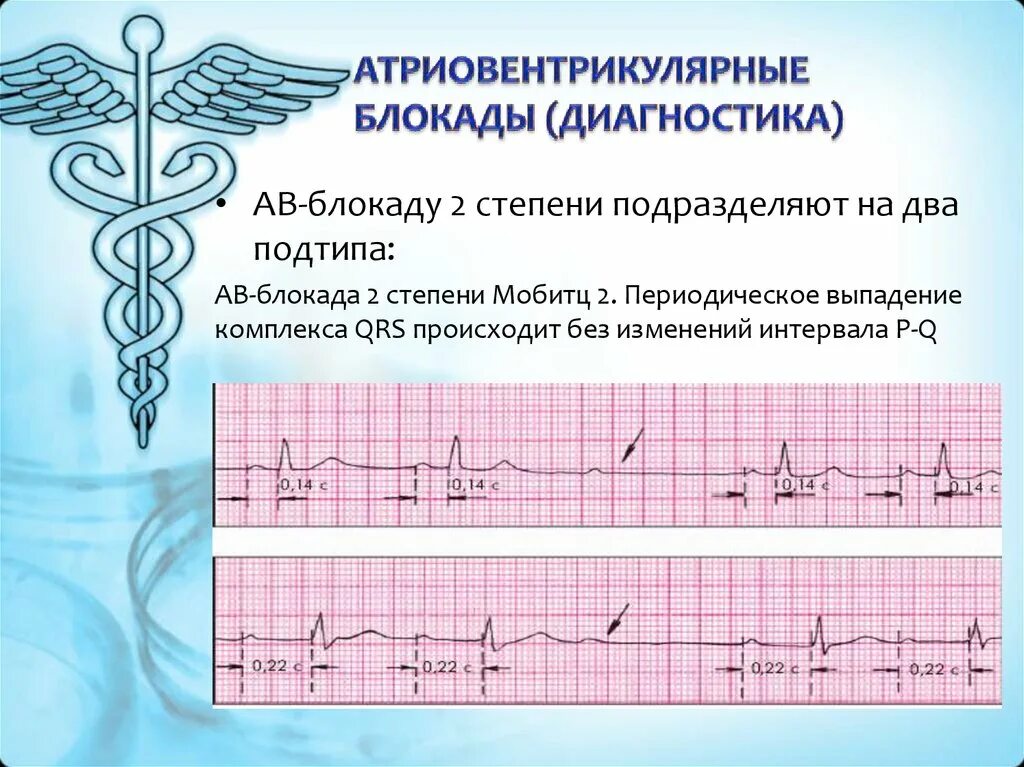 Клиника блокада боли оренбург. Атриовентрикулярная блокада 2 степени диагностируется при. Атриовентрикулярная блокада 3 степени диагноз. Диф диагноз АВ блокады 3 степени. Полная АВ блокада диагноз.