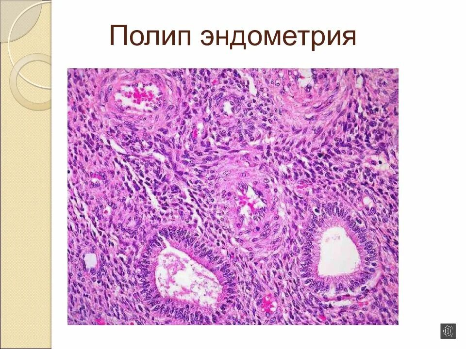 Гистология железисто-фиброзный полип. Железистый полип эндометрия гистология. Эндометриальный полип гистология. Грануляционный полип гистология.