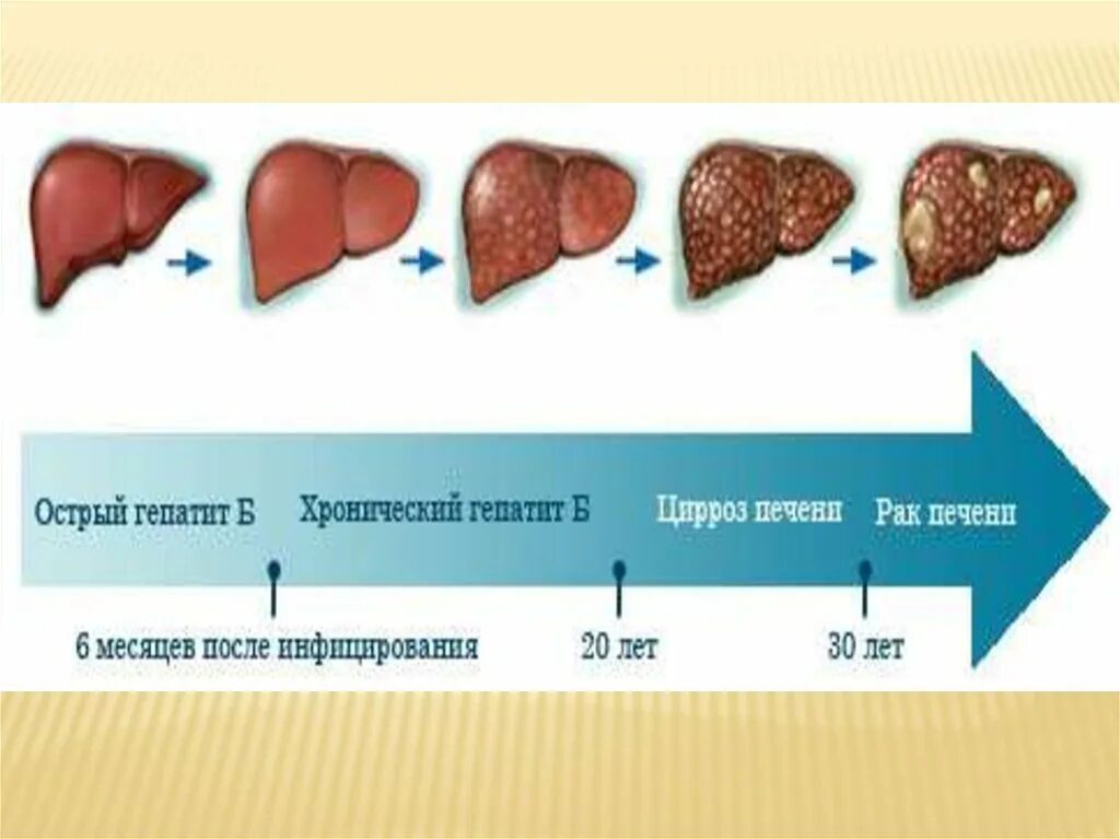 Ранние стадии печени. Стадии поражения цирроза печени. Цирроз печени стадии гепатит с. Хронический гепатит б стадии. Цирроз печени при гепатите b.