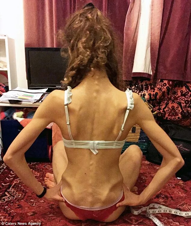 Anorexic teenager from Gothenburg doubles her body weight