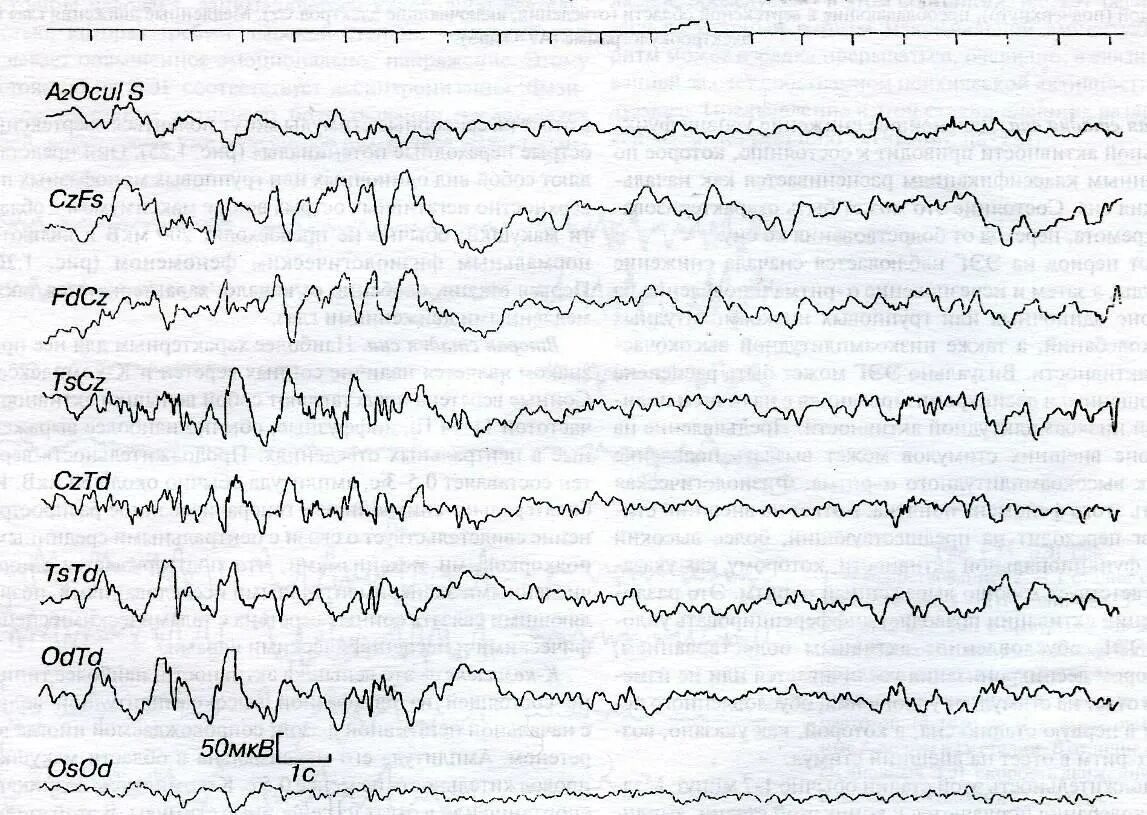 Ээг видеомониторинг сна. Электроэнцефалограмма фаз сна. Фазы сна на ЭЭГ. Медленные волны на ЭЭГ. ЭЭГ мониторинг сна.