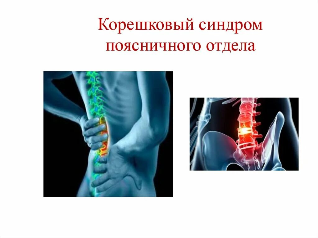 Остеохондроз поясничного отдела корешковый синдром. Корешковый синдром. Корешковый синдром поясничного отдела. Корешковый синдром поясничного отдела позвоночника. Невралгия корешковый синдром