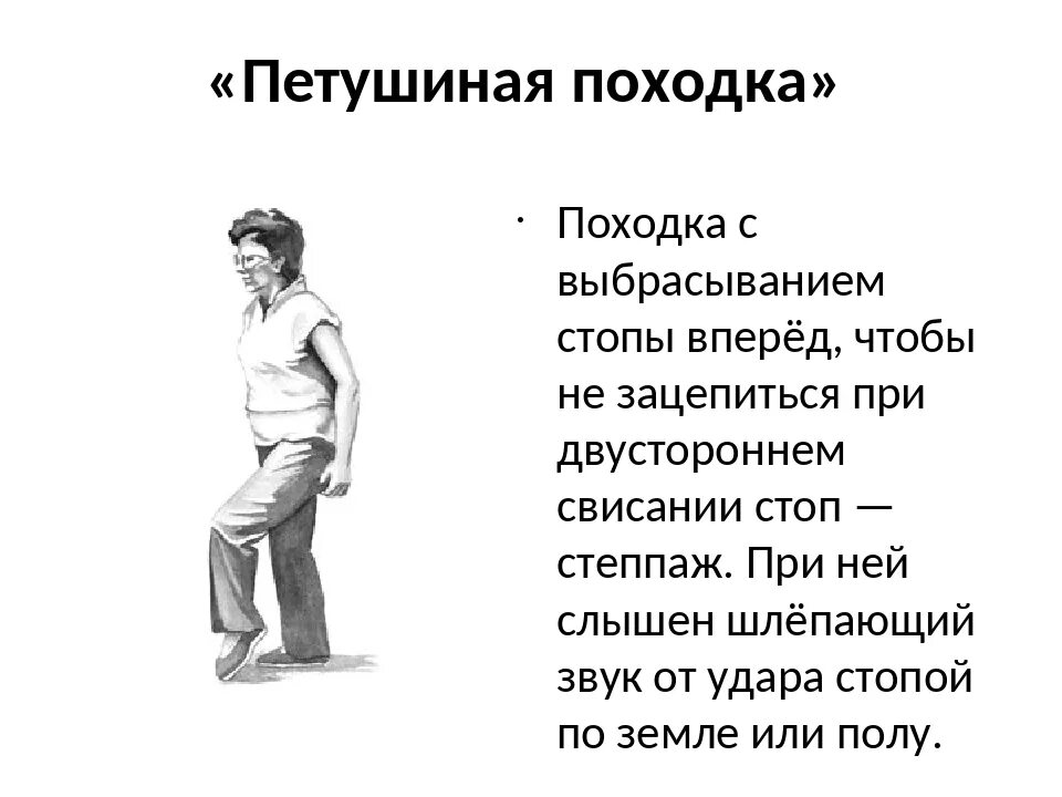 Поступь какая. Петушиная походка. Походка степпаж. Петушиная походка болезнь. Петушиная походка степпаж.