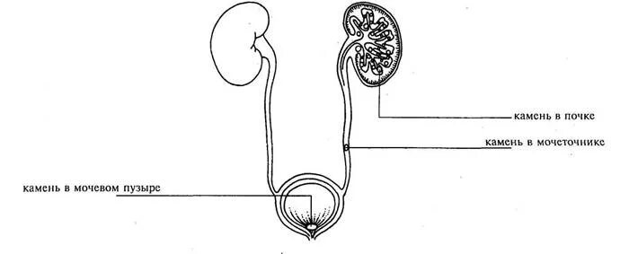 У мужчин не выходит моча у. Камни в почках мочеточнике и мочевом пузыре. Как выходит камень из почки у женщин схема. Движение камня из почки у мужчин схема. Почки мочеточники мочевой камень.