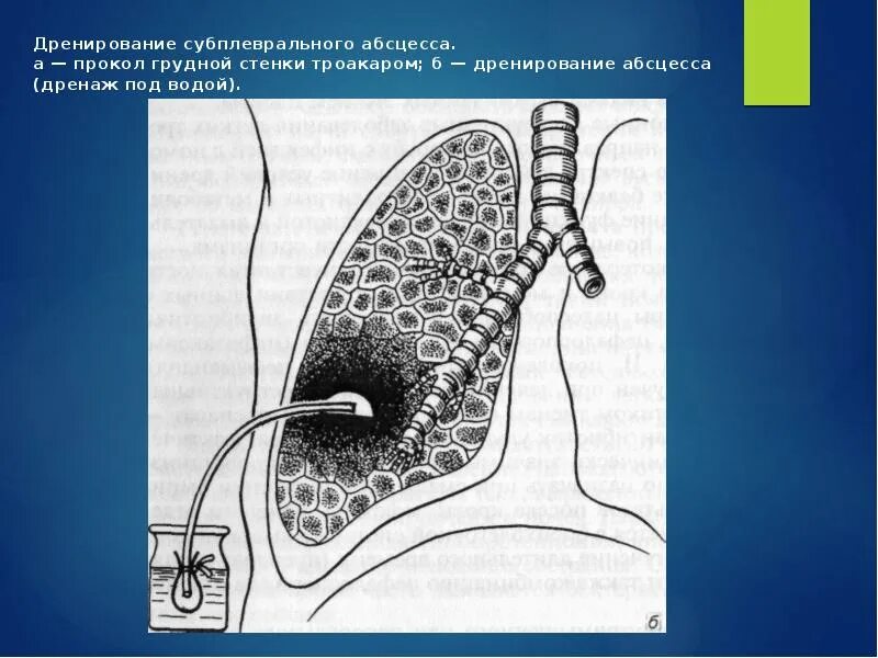 Дренаж при абсцессе