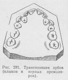 Зуб буквой т