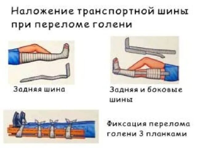 Кровотечение при открытом переломе голени. Наложение шины Крамера при переломе костей голени. При переломах костей конечностей накладывается шина:. Наложить шину Крамера при переломе голени. Шина Крамера при переломе кости голени.