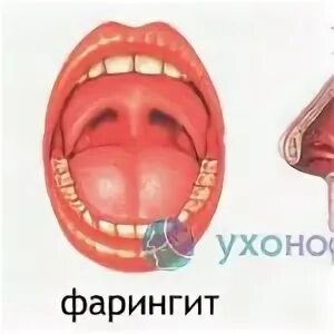 Ринофарингит это