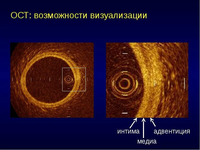 No reflow феномен