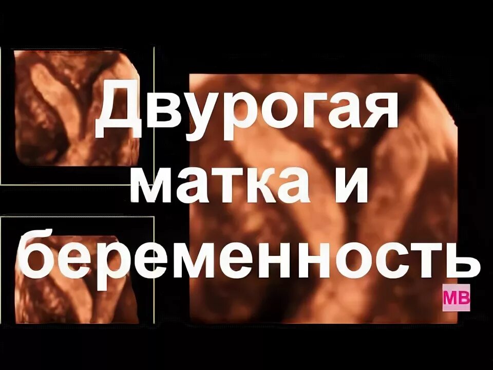 Двурогая матка месячные при беременности. Двурогая матка рентген. Гистеросальпингография двурогая матка. Двурогая матка с перегородкой. Двурогая матка месячные при беременности.