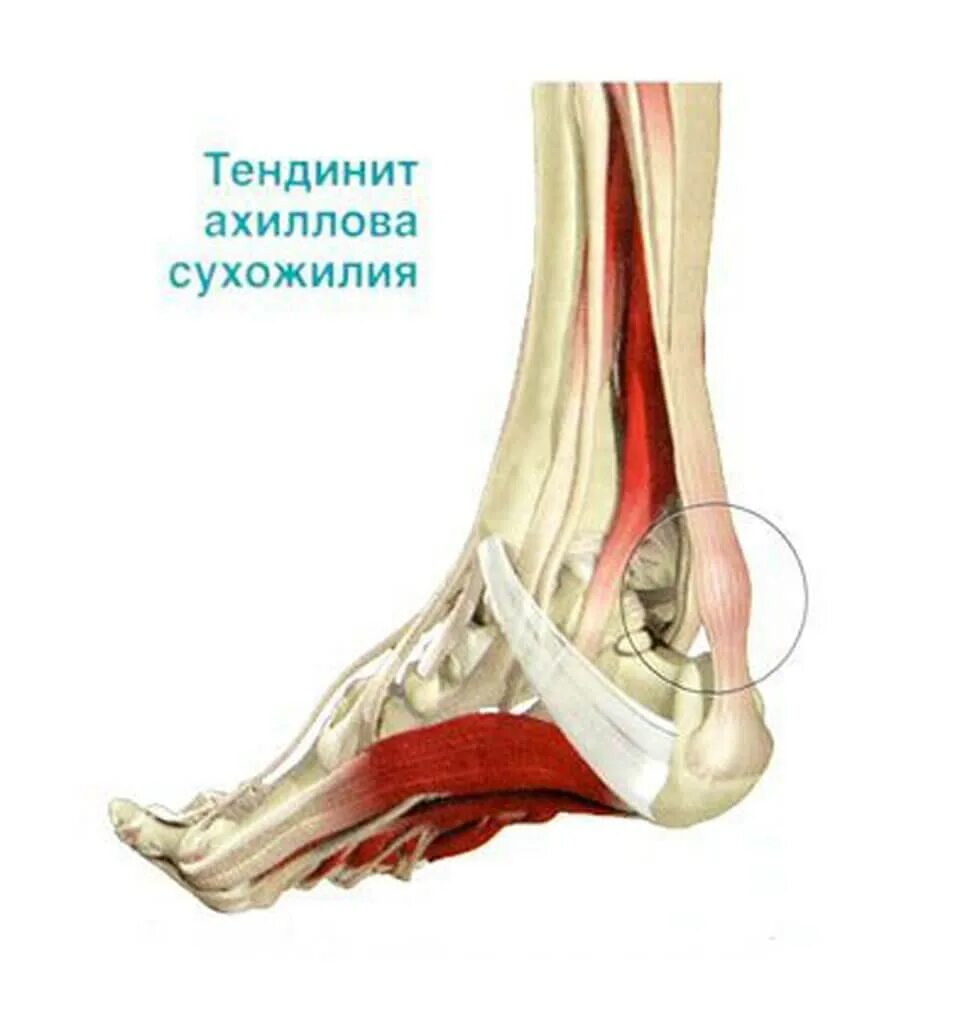 Почему болят сухожилия на ногах. Тендинит ахиллова сухожилия. Ахиллово сухожилие воспаление. Тендинит ахиллова стопы. Тендиноз ахилиллого сухожилия.