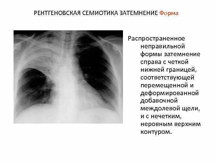 Рентгенологическая семиотика заболеваний легких. Затемнение с четкими контурами легкое. Затемнение неправильной формы с нечеткими контурами. Неровные контура на рентгенограмме.