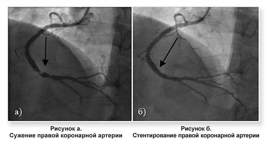 Стеноз инвалидность. Коронарные артерии стеноз стент. Коронарография инфаркт миокарда. Коронарография при инфаркте миокарда. Правая коронарная артерия ангиограмма.
