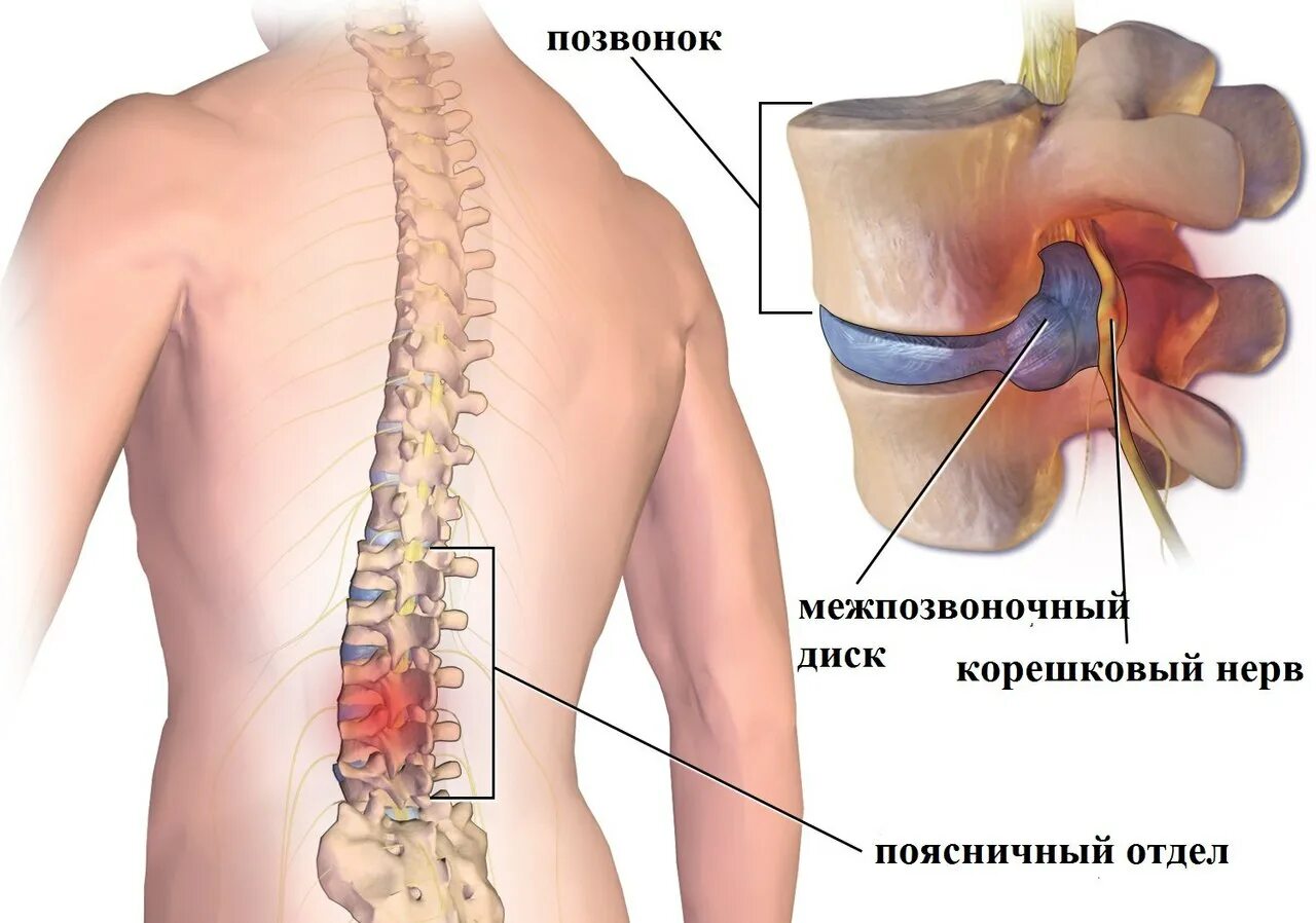Как понять что грыжа в пояснице. Как понять что грыжа в пояснице