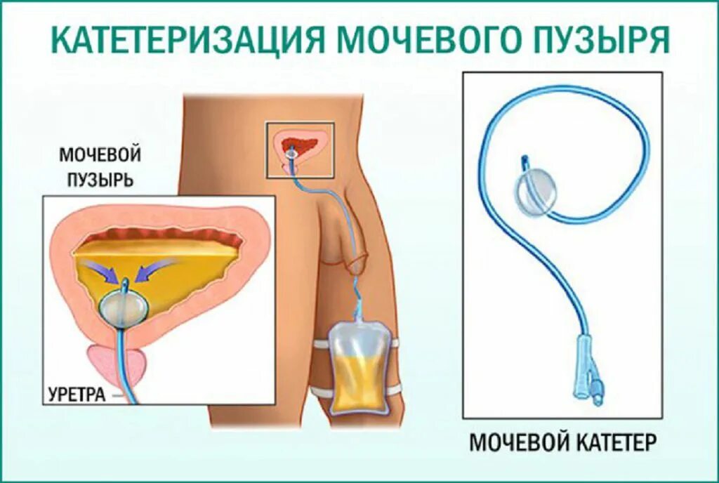 Моча после катетера
