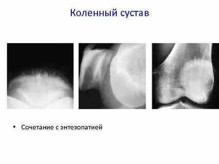 Энтезопатия что это
