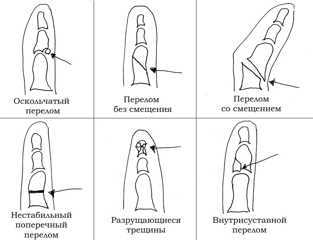 Перелом ногтевой фаланги 1 пальца. Классификация переломов ногтевой фаланги. Перелом фаланги мизинца симптомы. Перелом средней фаланги пальца гипс. Как понять что у тебя трещина