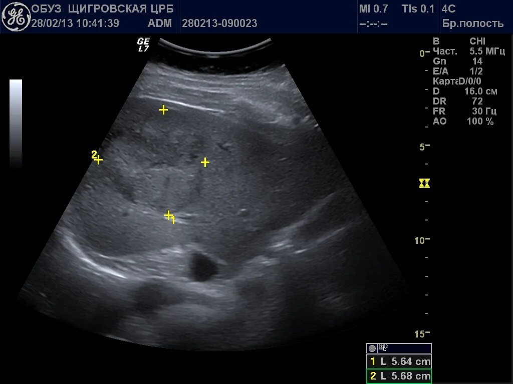 Ультразвуковое исследование печени. Нормальная печень.. Ультразвуковое исследование желчного пузыря. УЗИ брюшной полости цирроз печени. Видна ли опухоль на узи