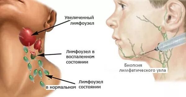 Лимфоузел после химиотерапии. Биопсия лимфатических узлов. Пункционная биопсия лимфоузлов. Пункция лимфатического узла. Эксцизионная биопсия лимфоузла.