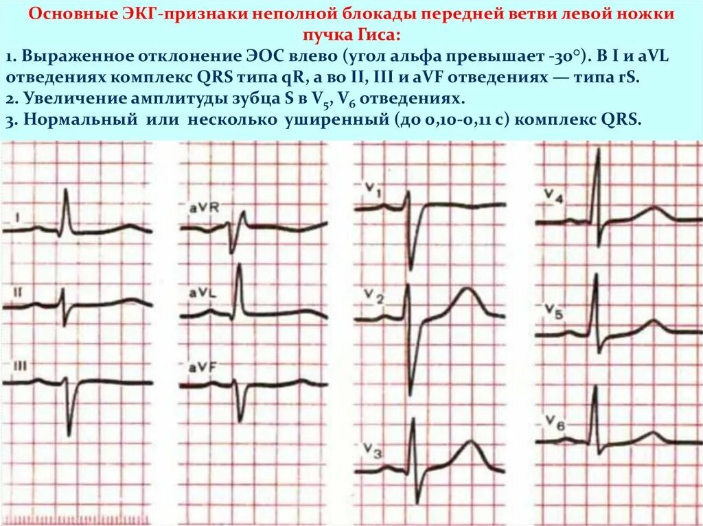 Блокада левой задней ножки. ЭКГ при неполных блокадах ножек пучка Гиса. АВ блокада левой ножки пучка Гиса на ЭКГ. Отклонение ЭОС влево, блокада передней ветви левой ножки пучка Гиса;. Блокада правой и левой ножки пучка Гиса на ЭКГ.