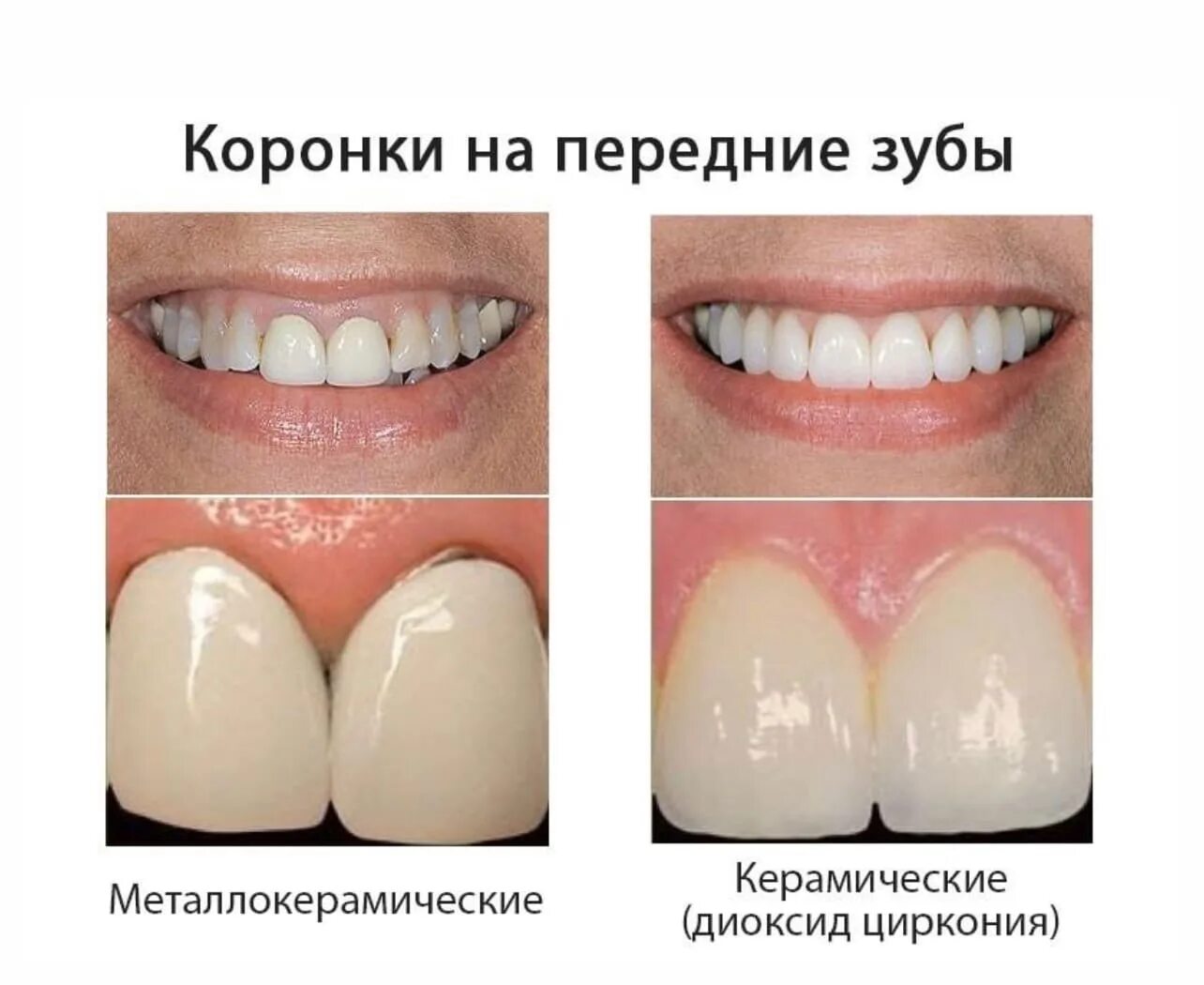 Цирконий зубы плюсы и минусы. Коронки из диоксида циркония на передние зубы. металлокерамика и диоксид циркония. коронка диоксид циркония и металлокерамика. диоксид циркония коронки.