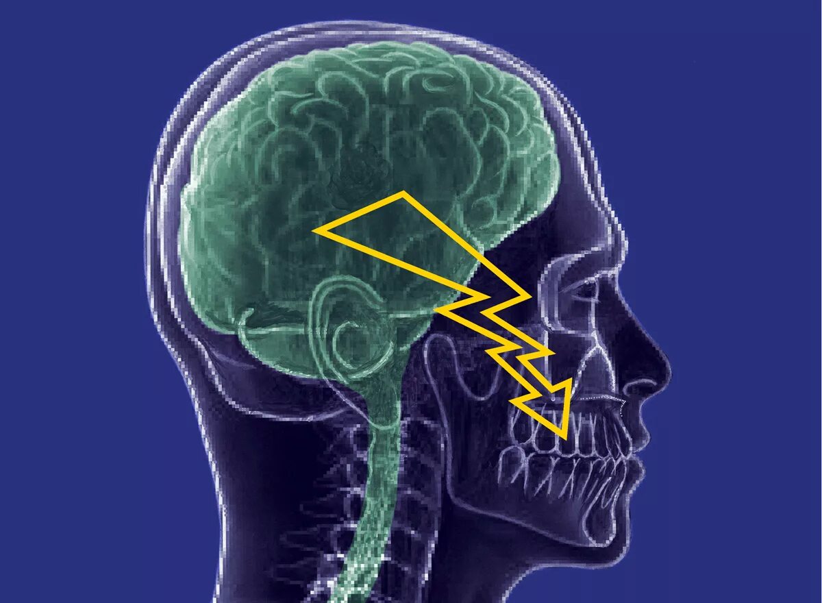 Neuralgia тройничный нерв. Первичная невралгия тройничного нерва. Невралгия тройничного нерва неврология. Тригеминальная невралгия тройничного нерва. Невропатия затылочного