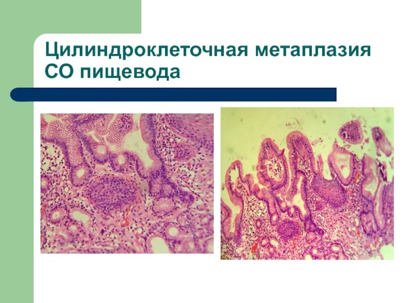 Метаплазия желудка отзывы. Бокаловидноклеточная метаплазия. Метаплазия желудочного эпителия дисплазия. Цилиндроклеточная метаплазия пищевода. Кишечная метаплазия пищевода.