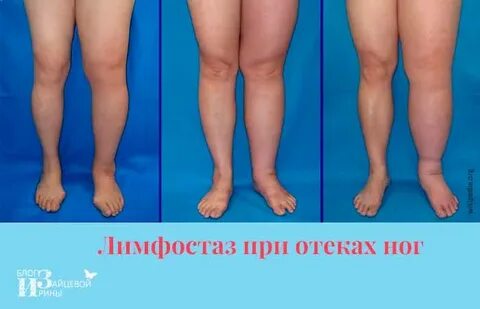 Причины лимфостаза лечение