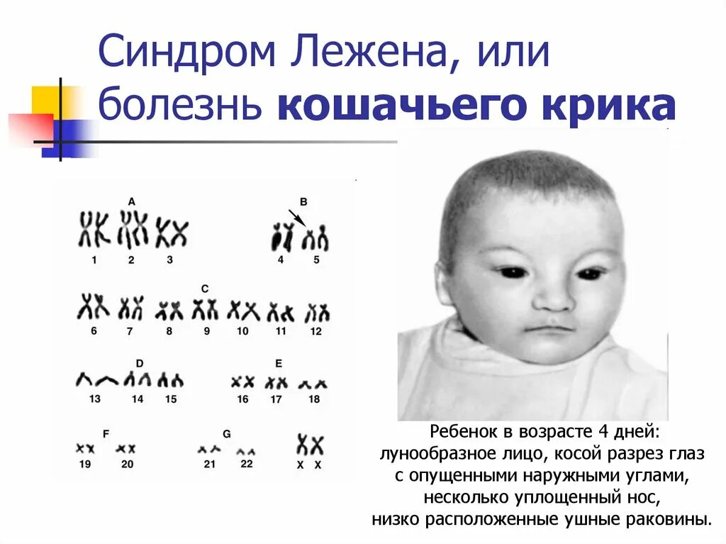 4 хромосома заболевание. Кариотип больного с синдромом кошачьего крика. Синдром кошачьего крика (моносомия 5р). Правильная формула кариотипа при синдроме кошачьего крика. Кариограмма человека с синдромом кошачьего крика.