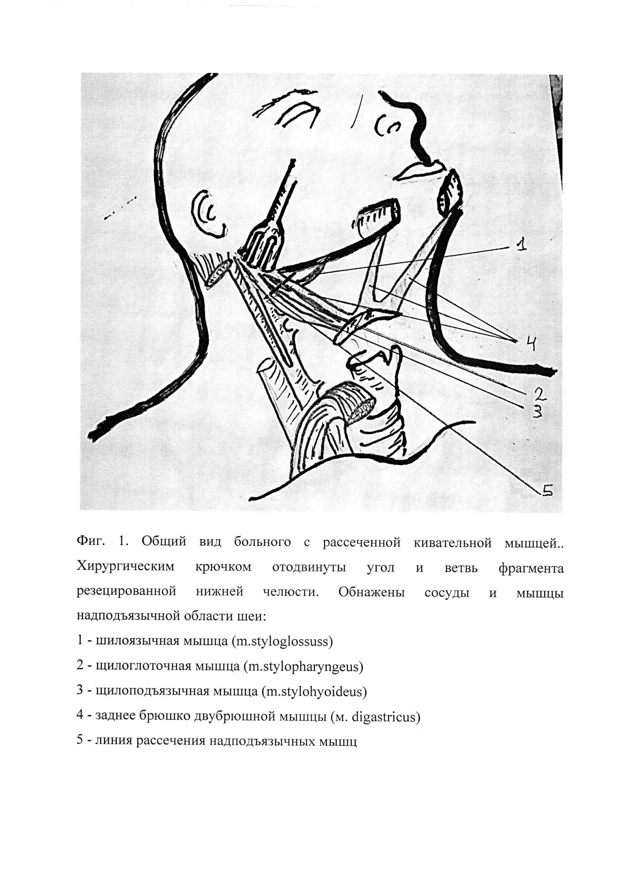 Лимфаденэктомия это. Операция Ванаха и Крайля. Лимфаденэктомия шейная. Операция Ванаха и Крайля топографическая анатомия.