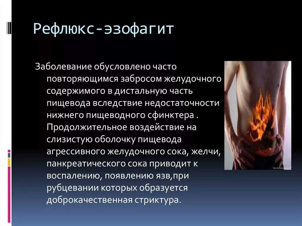 Рефлюкс 4. Рефлюкс эзофагит с эзофагитом. Дистальный эрозивный рефлюкс-эзофагит. Неэрозийной рефлюкс-эзофагит.