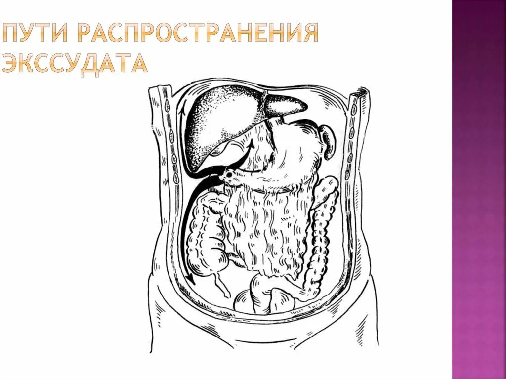 Распространенный Гнойный перитонит. Воспалительный экссудат в брюшной полости. Перитонит брюшной полости.