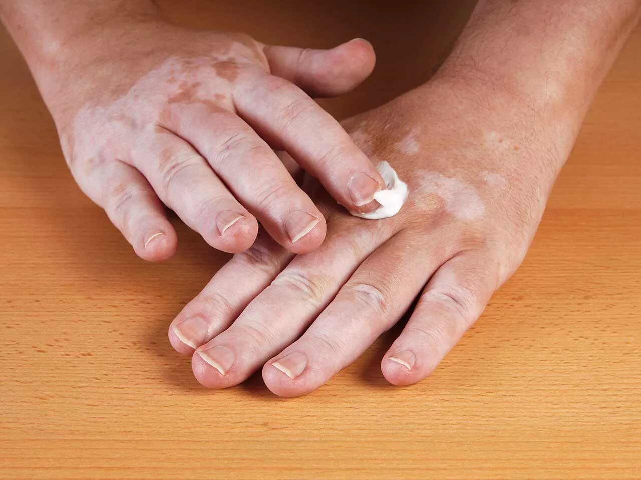 народные средства для пяток. улучшение состояния кожи. мазь от псориаза и экземы. средство для пяток с глицерином. избавление от веснушек на лице.