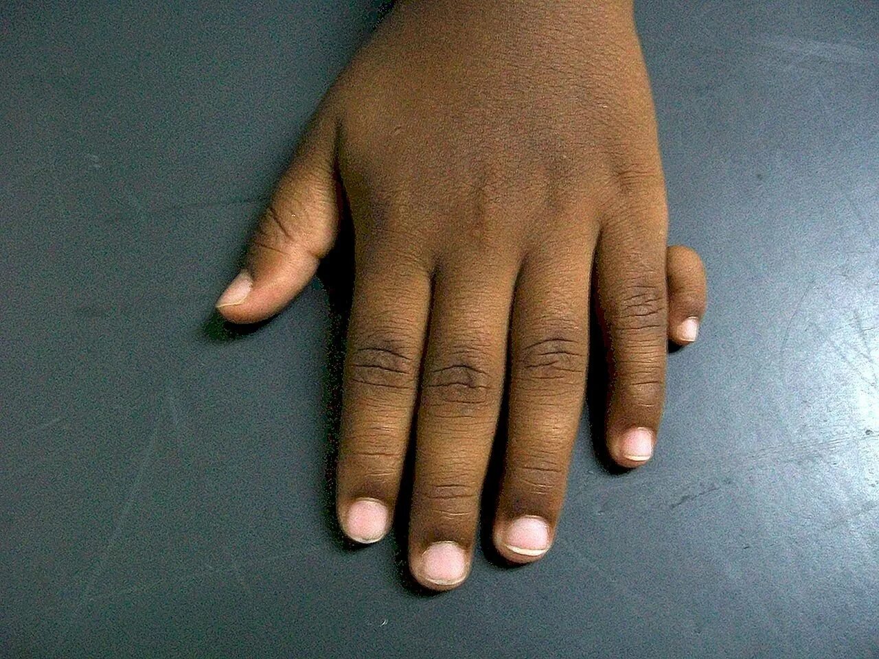 6 пальцев на руках у детей. Ульнарная полидактилия. Полидактилия Эрнандес Гарридо.