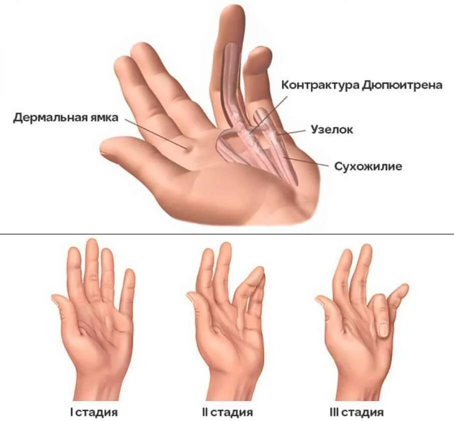 Изменения кисти рук. Заболевание кисти контрактура Дюпюитрена. Ладонный фиброматоз (контрактура Дюпюитрена). Контрактура Дюпюитрена начальная стадия. Стадии заболевания контрактуры Дюпюитрена.