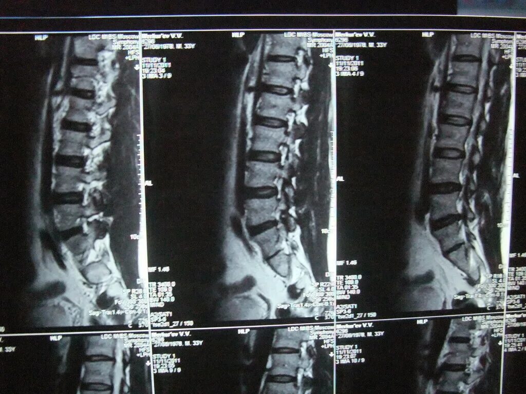 Позвоночник отдел l3 s1. Протрузия диска l4-s1. Диск сегмент l4-5-s1. Диски позвонков l3-l4, l4-l5, l5-s1. Спондилоартроз l3-l4, l4-l5 l5-s1.