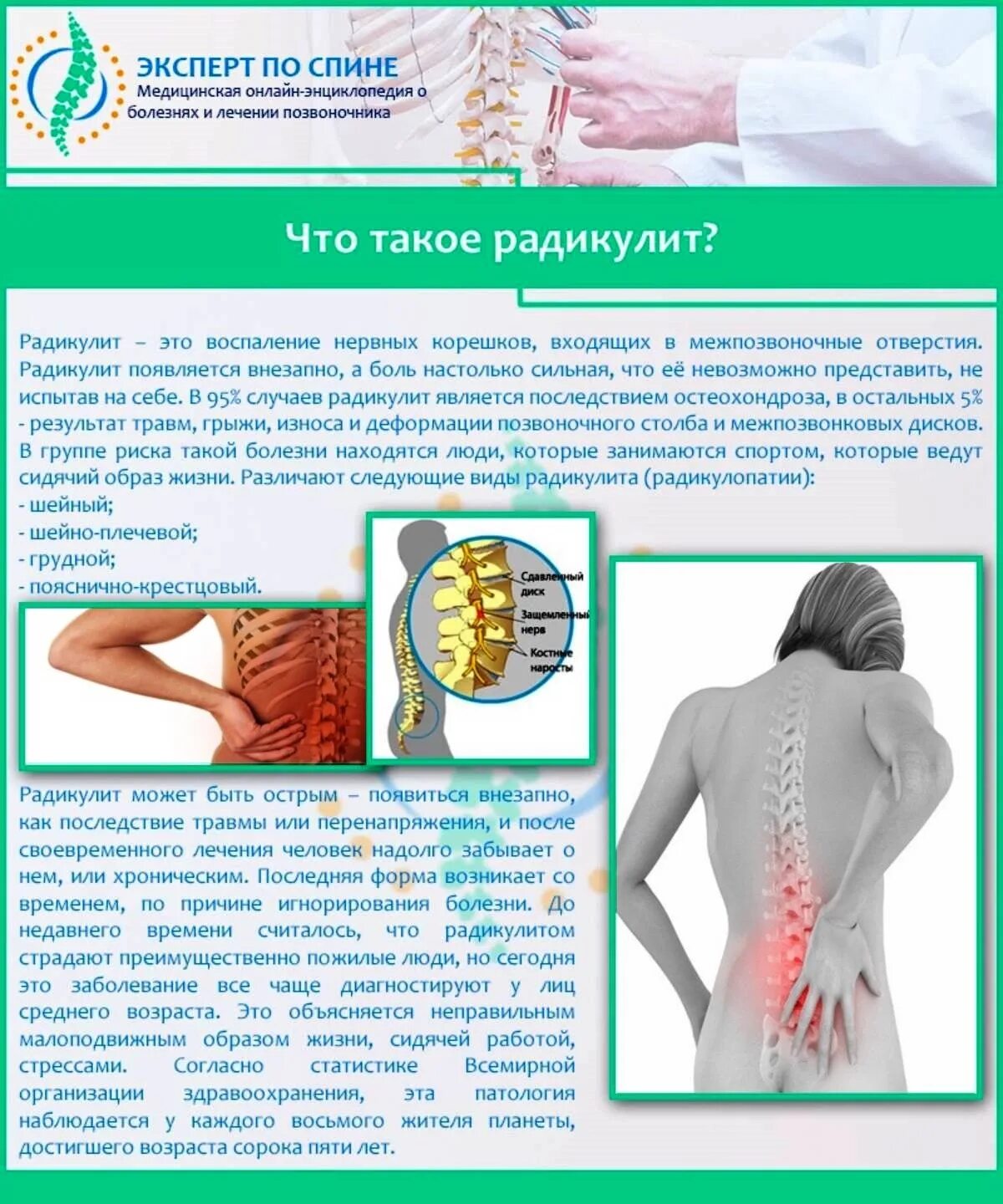 Радикулит поясница. Пояснично-крестцовый радикулит симптомы. Клинический симптом пояснично-крестцового радикулита. Пояснично крестцовая радикулопатия. Корешковый. Синдром. Люмбалгия корешковый синдром.