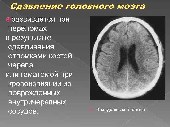 Черепно мозговые гематомы. Ушиб головного мозга со сдавлением. Сдавление головного мозга внутричерепными гематомами. Черепно-мозговая травма сдавление головного мозга. Травматическая компрессия головного мозга.