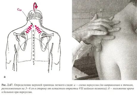 Перкуссия алгоритм