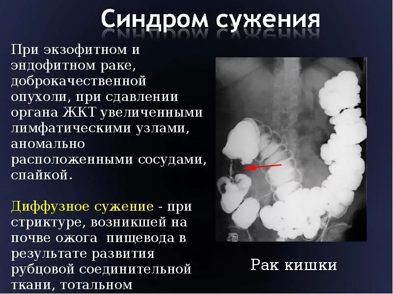 Рентгенологические синдромы патологии желудка. Стеноз желудка рентгенодиагностика. Опухоли толстой кишки экзофитный. Синдром пищевода