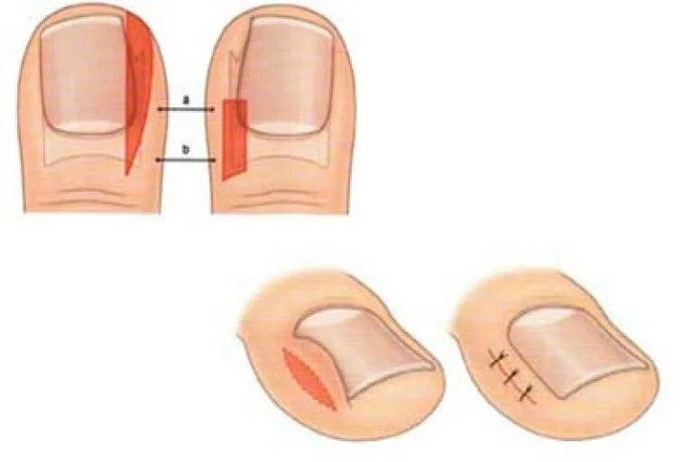 Онихокриптоз вросший ноготь операция. Вросший ноготь на большом пальце ноги. Онихокриптоз воспаление. Пластика бокового околоногтевого валика. Впился ноготь что делать