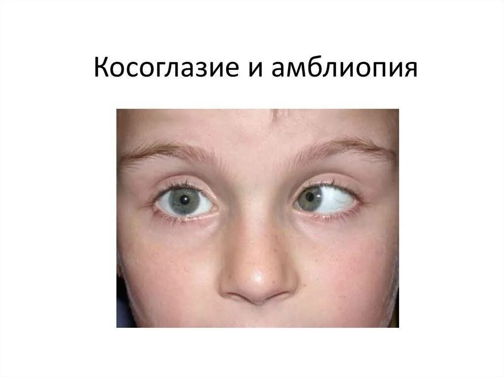 Амблиопия форум. Амблиопия (синдром ленивого глаза). косоглазие и амблиопия. дети с косоглазием и амблиопией. косоглазие ас амблиапиец.