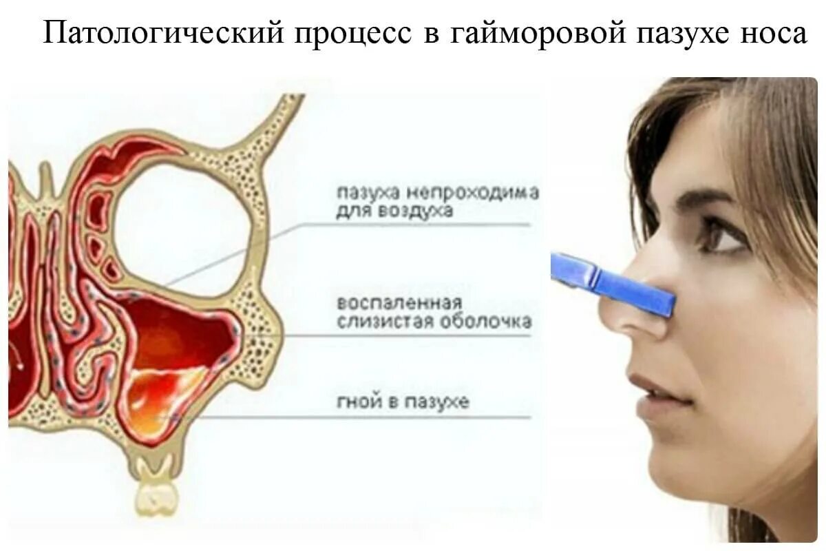 Сильные боли при гайморите. Воспаление гайморовых пазух.