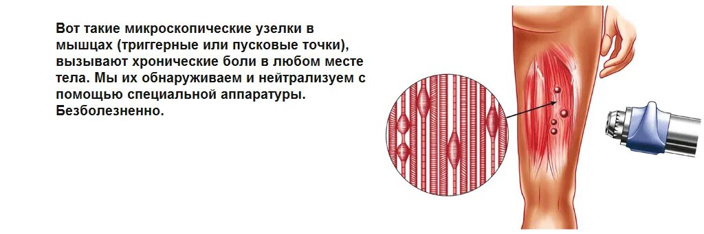 Триггерные точки это простыми словами. Триггерные точки лечение мышц. Триггер в мышце, фиброз мышц.. Триггеры это в медицине.