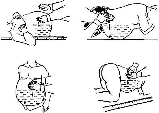 Препараты при асците. Водянка асцит симптомы. Способы выявления асцита. Метод флюктуации при асците. Оценка свободной жидкости в брюшной полости.